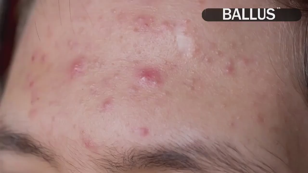 Load video: Pore Cleaning Device